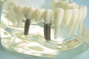 2 single dental implants with a crown on top and a clear jaw model holding it together