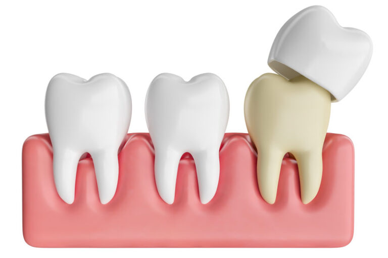crowns getting placed on top of a damaged tooth