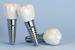 Realistic dental implants with ceramic crowns and titanium screws on a blue background